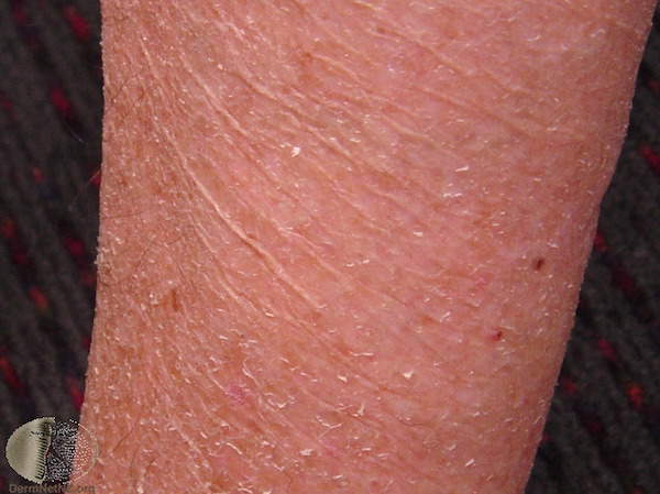 How do you treat dry, scaly skin spots?