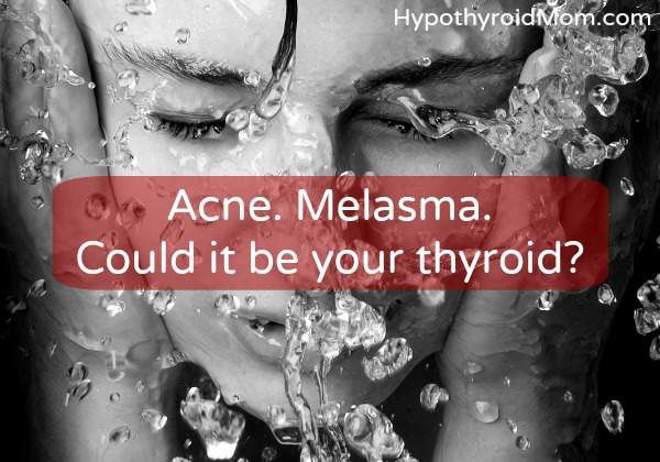 Does hypothyroidism cause acne?