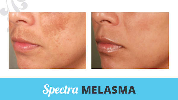 Acne. Melasma. Could it be your thyroid?
