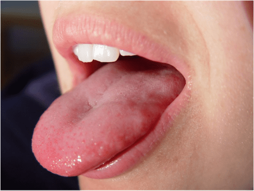 What Your Tongue Tells You About Your Thyroid