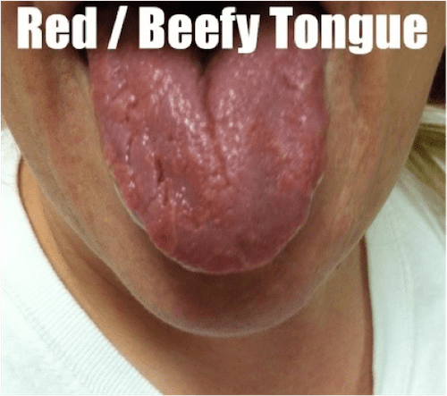 Of tongue in middle split 