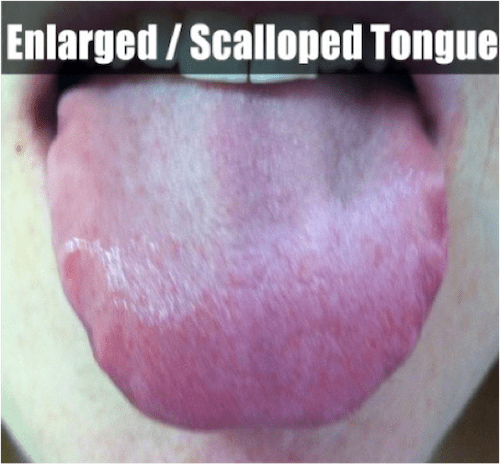 What Your Tongue Tells You About Your Thyroid Hypothyroid Mom 