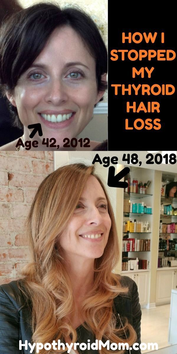 How I stopped my thyroid hair loss