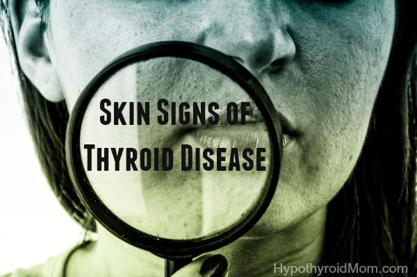 Skin Rash Hypothyroidism