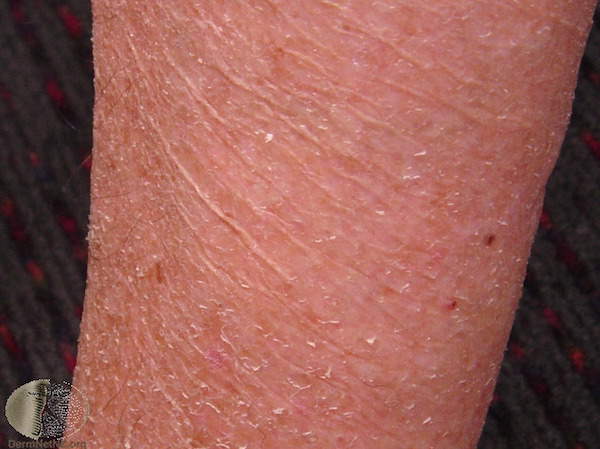 hypothyroidism skin rash