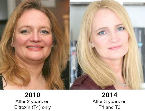 From Hypothyroid to Healthy