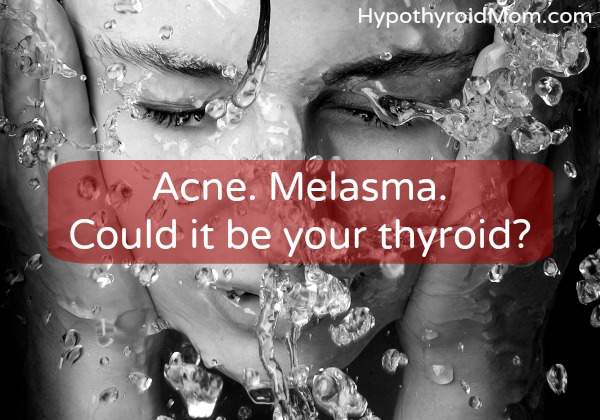 Acne. Melasma. Could it be your thyroid?