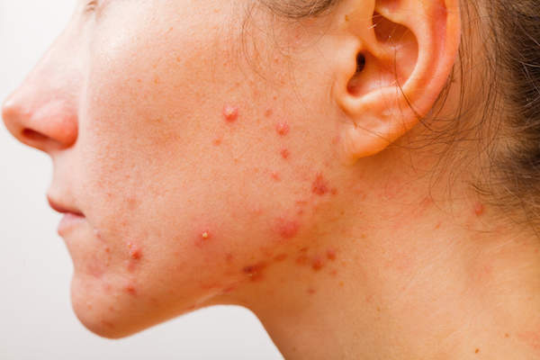 Acne. Melasma. Could it be your thyroid?
