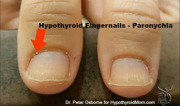 Hypothyroid Fingernails