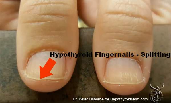 do-you-have-hypothyroidism-look-at-your-hands