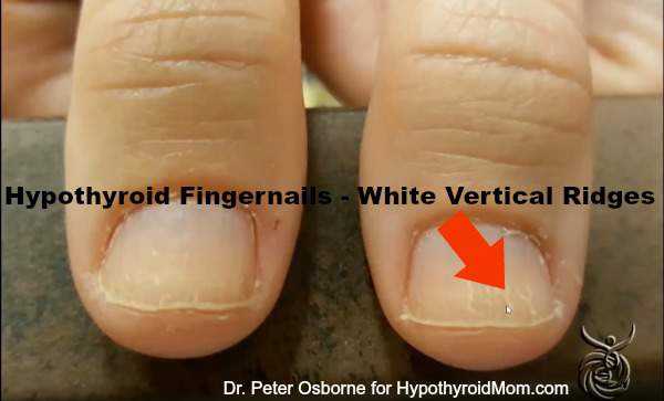 vertical lines on nails