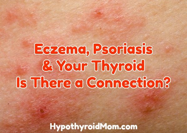 Eczema, Psoriasis & Your Thyroid