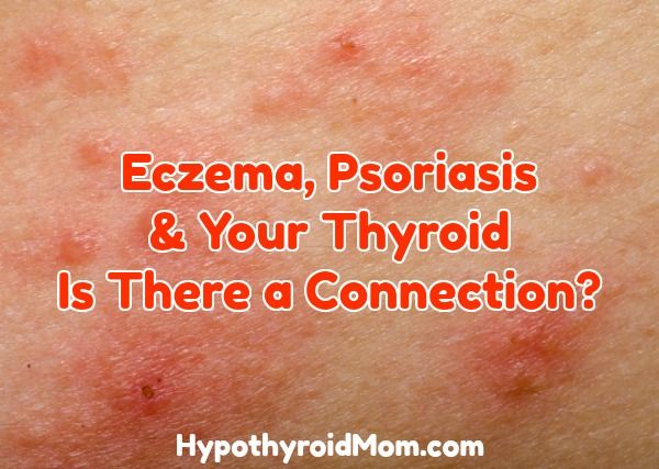 Eczema Psoriasis And Your Thyroid Is There A Connection Hypothyroid Mom