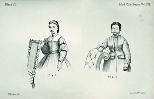 1878 First documented recording of a photo of a woman with myxedema (hypothyroidism) by W.M. Ord