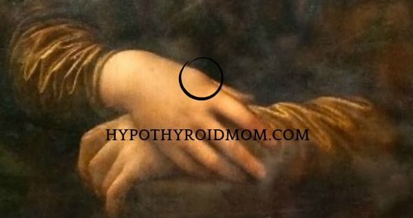 Mona Lisa: Classic Signs of Hypothyroidism in the World's Most