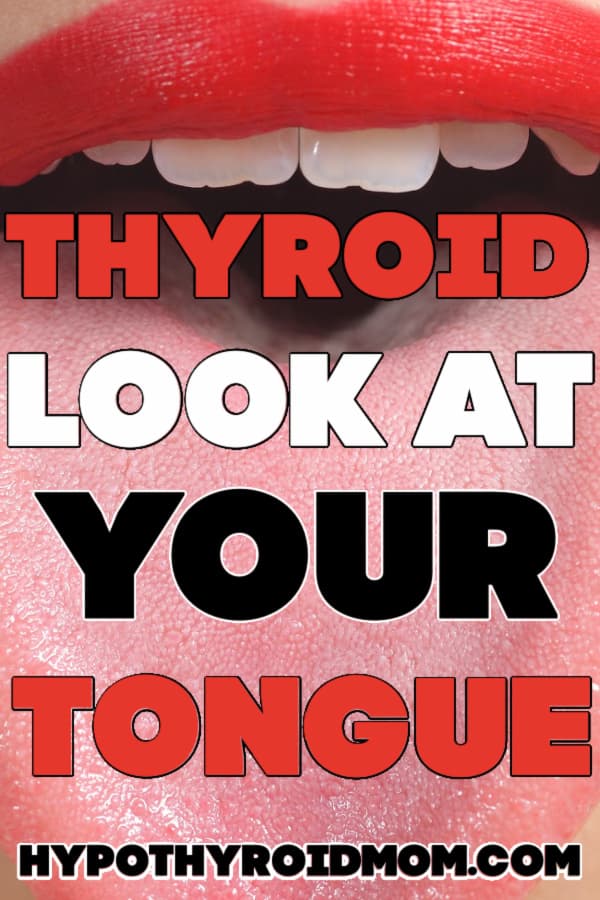 enlarged swollen scalloped tongue in hypothyroidism