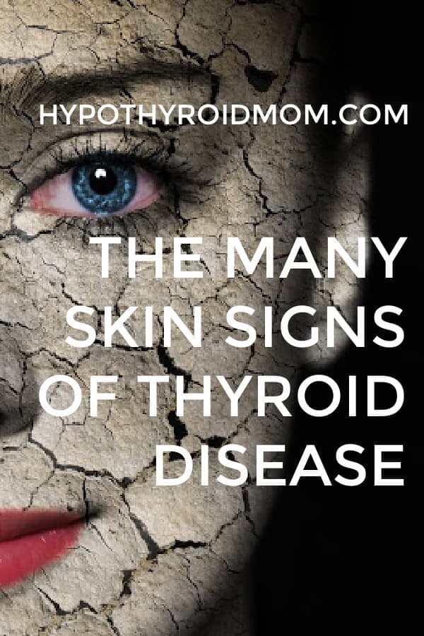 skin dermatological signs of thyroid diseases